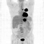 Profil neoplasm pulmonar